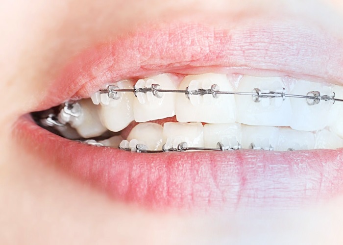 Керамические брекеты на зубах
