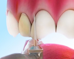 Подготовка зуба